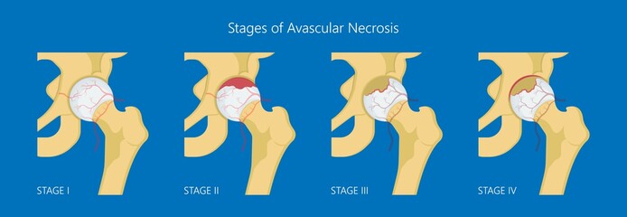 Avascular necrosis bone tissue disease