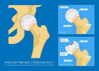 Avascular necrosis bone tissue disease - obrazy, fototapety, plakaty