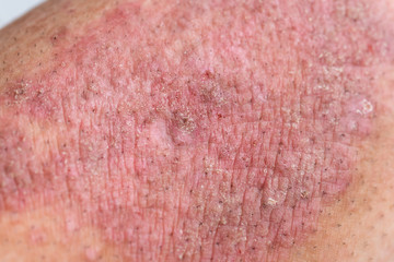 乾癬・皮膚炎・湿疹