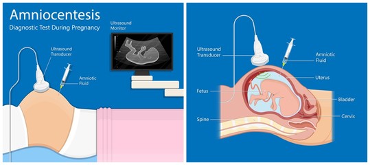 Amniocentesis diagnostic test treat LAB analysis chromosome DNA gene abnormal © Pepermpron