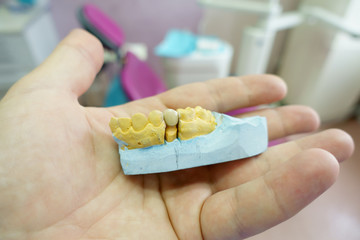 close-up ceramic tooth crown on a plaster model of teeth in the dentist's hand