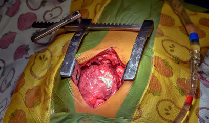 Ross's operation is the surgical treatment of aortic valve defects.