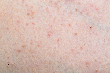 Fototapeta premium A close up shot of an allergic skin