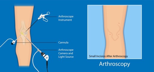 Arthroscopy medical treatment surgery keyhole surgical treat endoscope