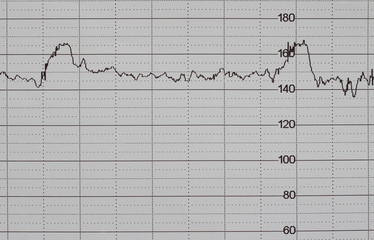 ecg graph, electrocardiogram ekg