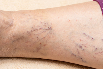 Varicose veins in a lady's leg. Abnormal and saccular dilations of the veins.