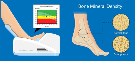 Bone mineral density BMD osteoporosis dual energy X-ray absorptionmetry adult disease equipment medical clinic central DXA pain radiography hospital fragility risk examine - obrazy, fototapety, plakaty