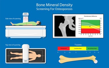 Bone mineral density BMD osteoporosis dual energy X-ray absorptionmetry adult disease equipment medical clinic central DXA pain radiography hospital fragility risk examine