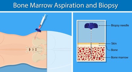 Bone biopsy medical marrow harvest stem cell transplants aspiration specimen cancer procedure sample test treatment diagnosis anemia blood cell lab