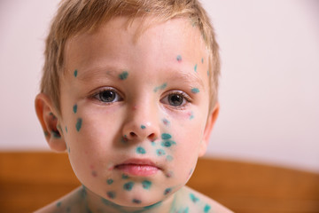 Young toddler,boy with chickenpox. Sick child with chickenpox. Varicella virus or Chickenpox bubble rash on child body and face.