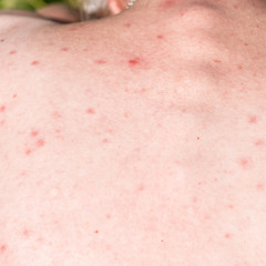 Fototapeta premium Red acne on the skin of the back of a young woman