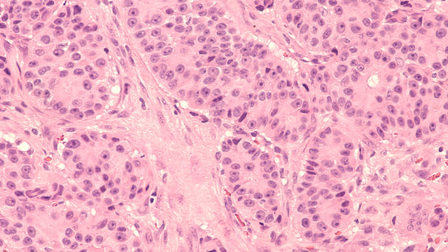 Prostate Cancer Oncology Awareness: Photomicrograph of core biopsy of prostate gland showing histology of prostatic adenocarcinoma with prominent nucleoli in patient with elevated PSA. 
