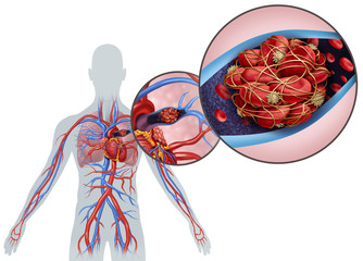 Pulmonary Embolism Anatomy - obrazy, fototapety, plakaty