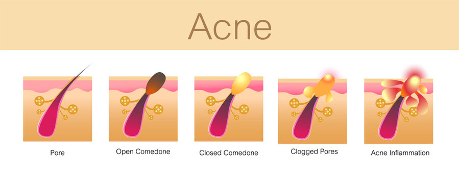 Acne,stages of development,healthy skin,vector design
