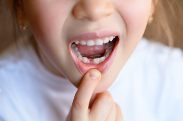 Cute preschooler showing her milk tooth fell out and her growing permanent tooth in open mouth. Beautiful smiling preschool girl lost baby tooth. Dental hygiene concept