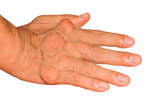 Severe gout in men suffering from joint pain, bone pain, gout, rheumatoid symptoms, radioactive sickness, ill man concept of male osteoporosis, injured bone, injury, pain, arthritis,arm, foot, knee