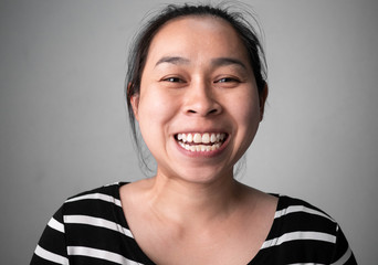 Smiling woman's teeth revealing  white spots and plaque on the tooth surface with abnormal tooth structure, The lower teeth protrude to the front. Oral care and Dental concept.