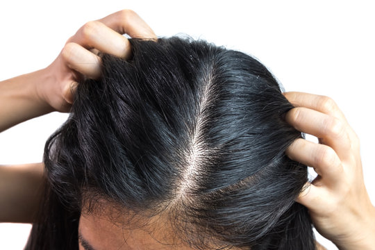 women head with dandruff Caused by the problem of dirty. Or caused by skin disease or Seborrheic Dermatitis. It has white scaly and it will cause itch. isolated on white background and clipping path.
