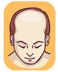 Man Pattern Baldness Top Hair Loss Illustration