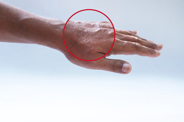 Closeup Erythematous rashes on the mans hands, papules and plaque, small macula redness and...