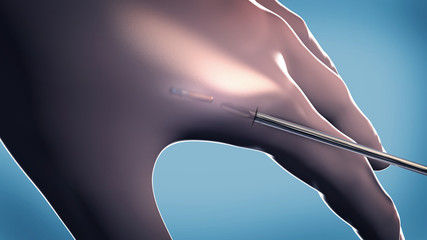 Sub dermal microchip implant or transponder implanted into human hand - 3d illustration - obrazy, fototapety, plakaty