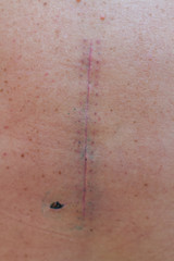 a large scar on the spine of a person from surgery