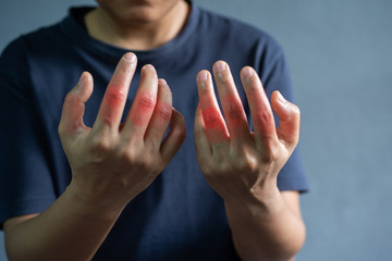 Painful hands patient gout on grey background.