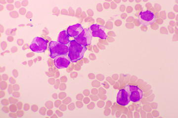 Acute promyelocytic leukemia cells or APL, analyze by microscope, original magnification 1000x