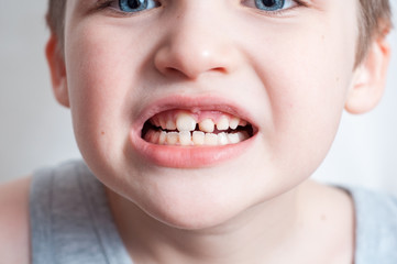 children's teeth, loss and fingers pointed at the incisor teeth, children's mouths of child close up, incisor milk tooth missing of kid