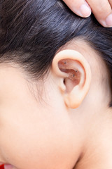 Lettuce seed in ear kid cure Lymphedema