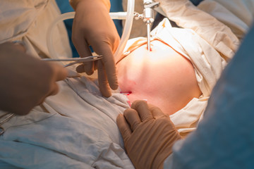 close-up hands of pediatric surgeons perform surgery using laparoscopic ports for endoscopic...