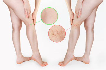 The concept of varicose veins and cosmetic treatment. A caucasian woman massages her legs with...