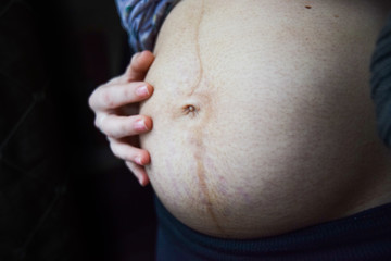 postpartum belly of pregnant woman with stretch marks