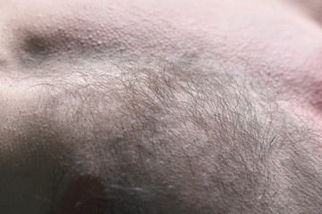 Fototapeta premium Male depilation. Half of male chest without hair after waxing. Close-up