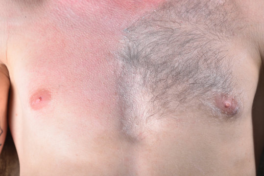 Male Depilation. Half Of Male Chest Without Hair After Waxing. Close-up