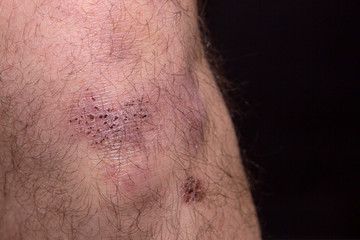 bruise and bruise on a man knee.