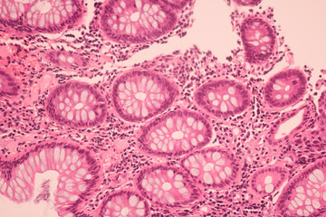 View in microscopic of ductal cell carcinoma, adenonocarcinoma from human breast cancer, tissue...