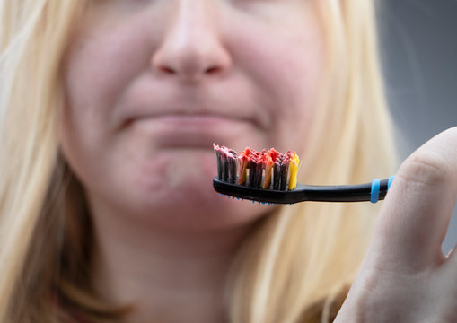 Toothbrush With Blood Closeup. A Woman Discovered Bleeding Gums While Brushing Her Teeth. Gingivitis Or Periodontal Disease