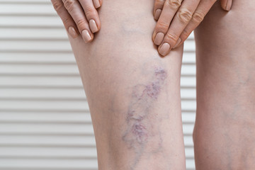 Woman shows leg with varicose veins. Varicose during pregnancy