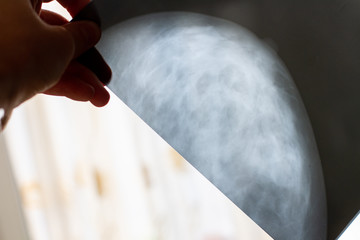 doctor holds an x-ray of a female breast in