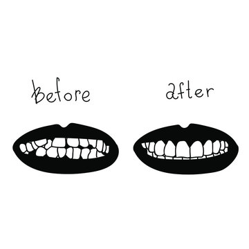 Before and after transformation process. Braces alignment progress, teeth changing form. Vector stock illustration in doodle style. 