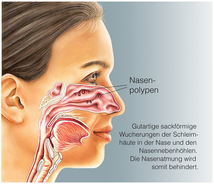 Nasenpolypen
