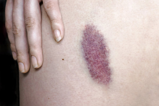 Ein H&auml;matom am Bein von einer Frau. Ein gro&szlig;er blauer Fleck auf der Haut bei einem Menschen