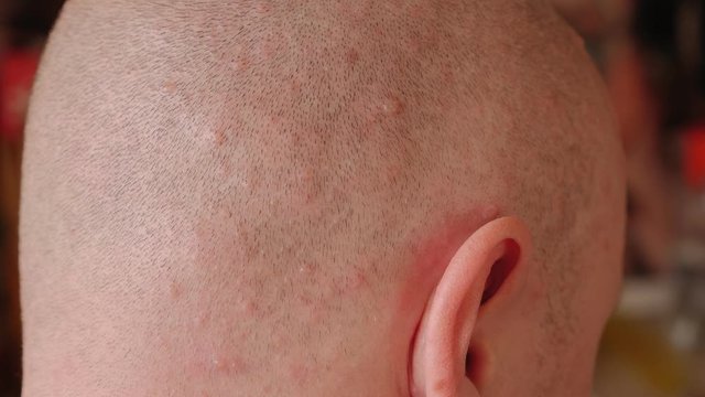 Close-up of a bald man's head with a rash on the skin from chickenpox. An adult male has varicella blister. Lots of red pimples on the skin. Slow motion.