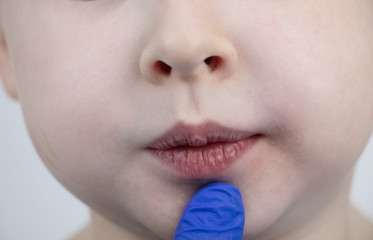 Chapped and dry lips in a child. A boy examined by a pediatrician in a hospital. Pediatrician...