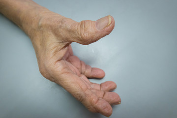 Mature patient with osteoarthritis