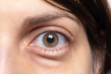 Bags under the eyes in a young Caucasian woman, closeup of the eye showing swelling in the eyelid