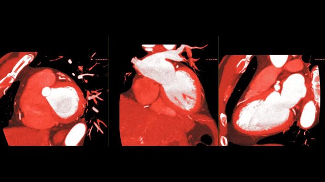 CTA Coronary artery compare vertical long axis, short axis and long axis view with MIP method for Detect coroary artery disease.