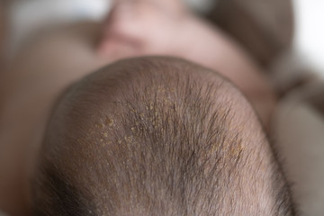 Small yellow dry peel crusts on the baby’s head. Seborrheic dermatitis, dandruff in the hair of a...