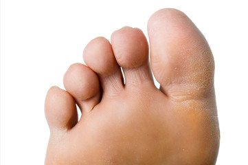 foot of a woman with dry and hardened skin
